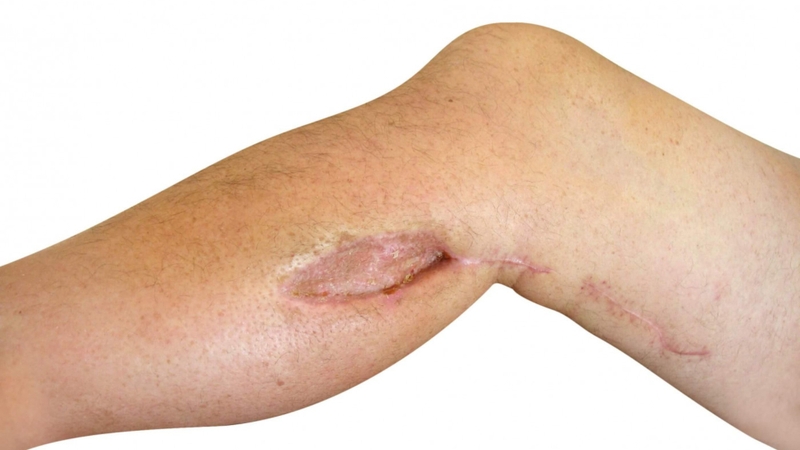 Hình ảnh vết mổ phục hồi sau phẫu thuật giải áp