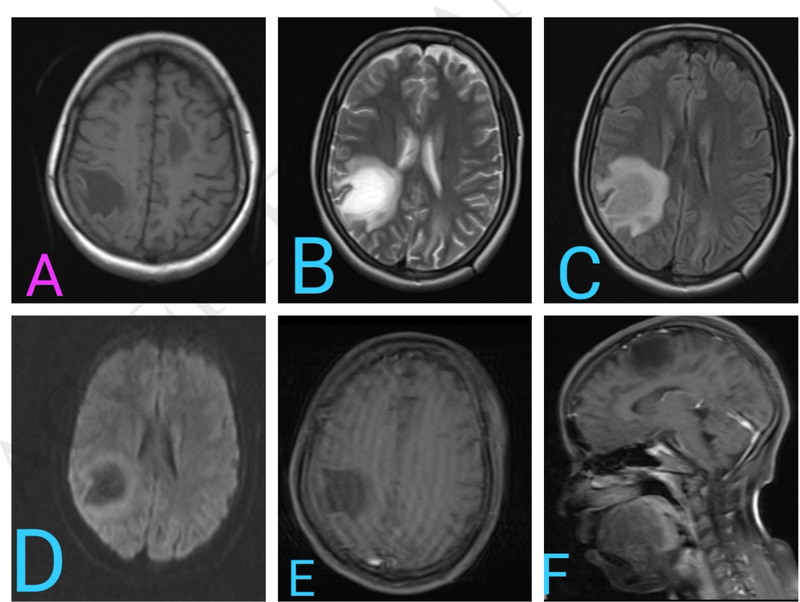 Hội chứng Cotard: Bệnh tâm thần hiếm gặp nhưng nguy hiểm 5