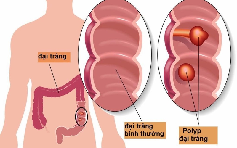 Hội chứng đa polyp MUTYH: Nguyên nhân, cơ chế di truyền và phương pháp tầm soát bệnh 1