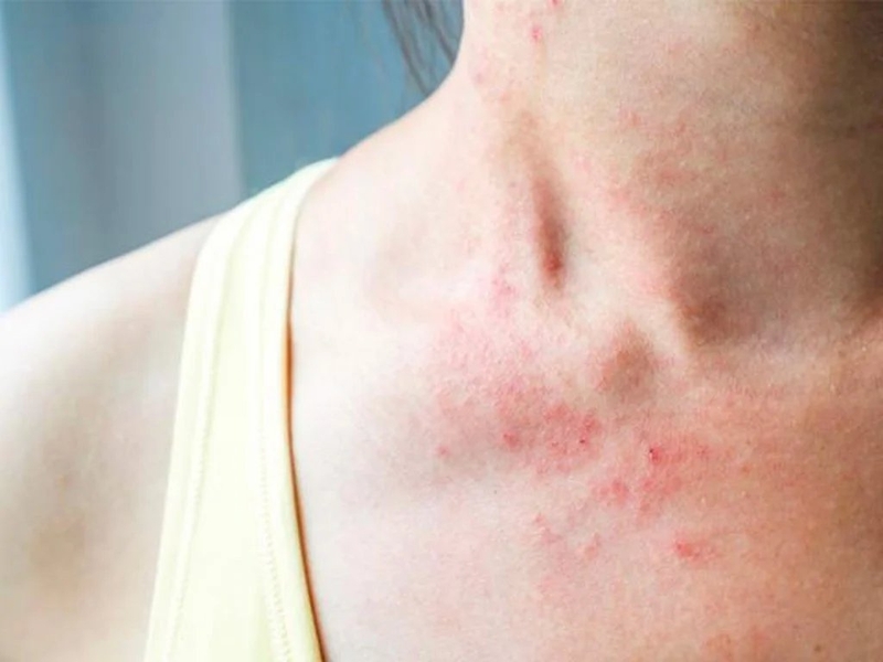 Hội chứng đáp ứng viêm hệ thống là gì? Dấu hiệu nhận biết 2