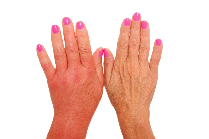 Hội chứng đau cục bộ phức tạp (CRPS): Nguyên nhân và dấu hiệu nhận biết bệnh 1