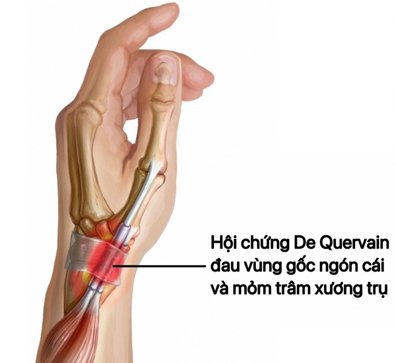 Hội chứng De Quervain là gì? Triệu chứng, chẩn đoán và điều trị