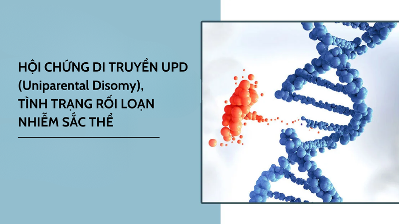 Hội chứng di truyền UPD: Hiểu rõ về tình trạng rối loạn nhiễm sắc thể 1