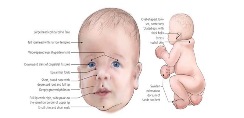 Hội chứng DiGeorge và những điều liên quan có thể bạn chưa biết 2