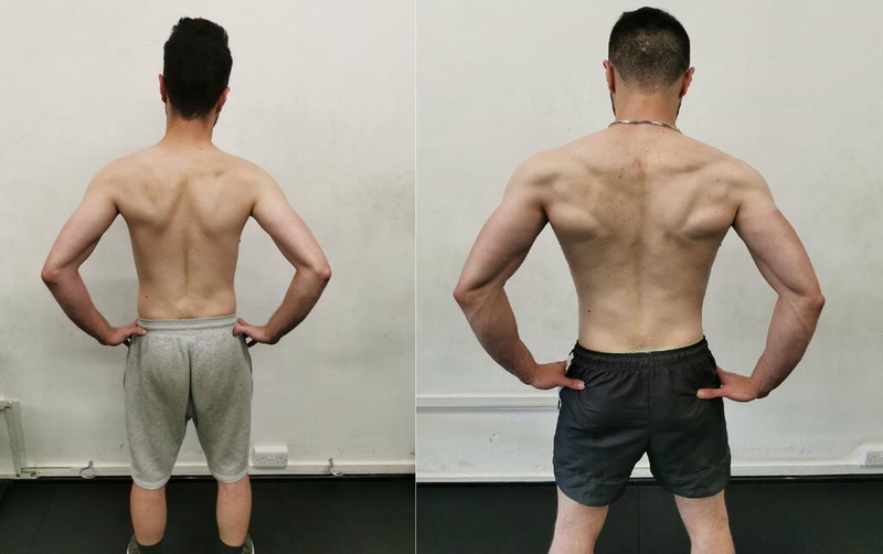 Hội chứng động mạch mạc treo tràng trên: Nguyên nhân, triệu chứng, chẩn đoán và điều trị 1