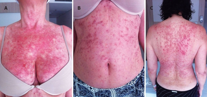 Hội chứng Dress là gì? Các dấu hiệu để nhận biết và cách điều trị như thế nào? 3