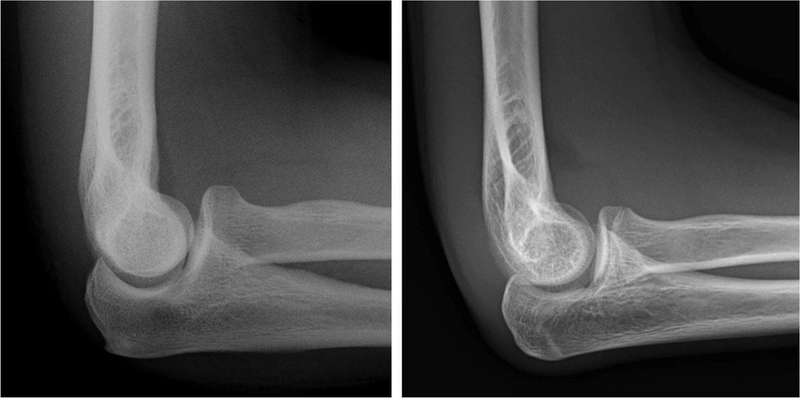 Hội chứng đường hầm xương trụ do nguyên nhân gì? Các biện pháp điều trị 3