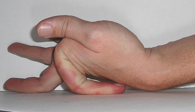 Hội chứng ehlers-danlos là gì? Những nguyên nhân và lưu ý về hội chứng ehlers-danlos 1