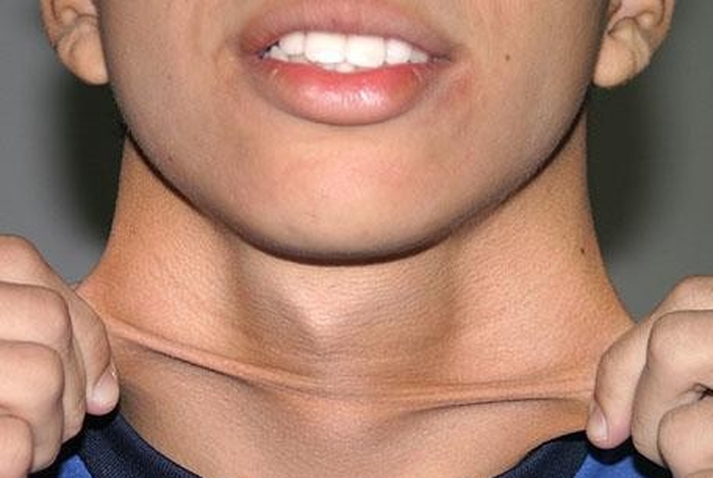 Hội chứng ehlers-danlos là gì? Những nguyên nhân và lưu ý về hội chứng ehlers-danlos 3