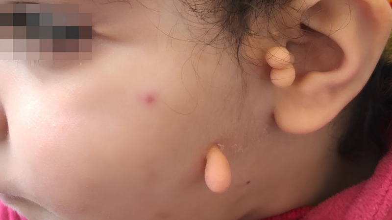 Trẻ mắc hội chứng Goldenhar có thể gặp bất thường về thính lực