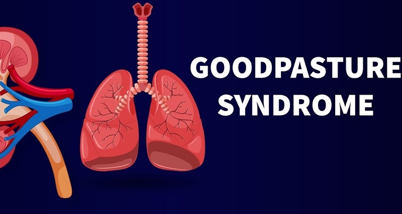 Hội chứng Goodpasture: Triệu chứng, chẩn đoán và phương pháp điều trị 1