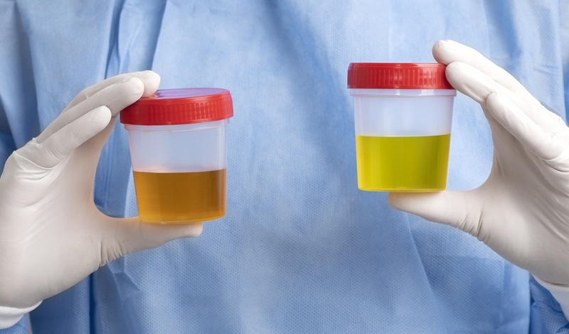 Hội chứng Goodpasture: Triệu chứng, chẩn đoán và phương pháp điều trị 3