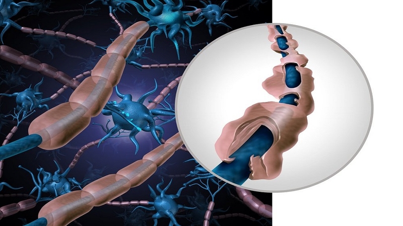 Hội chứng Guillain Barre biểu hiện các triệu chứng yếu cơ và dị cảm, bắt đầu ở chân và bàn chân sau đó lan dần ra cánh tay và thân mình