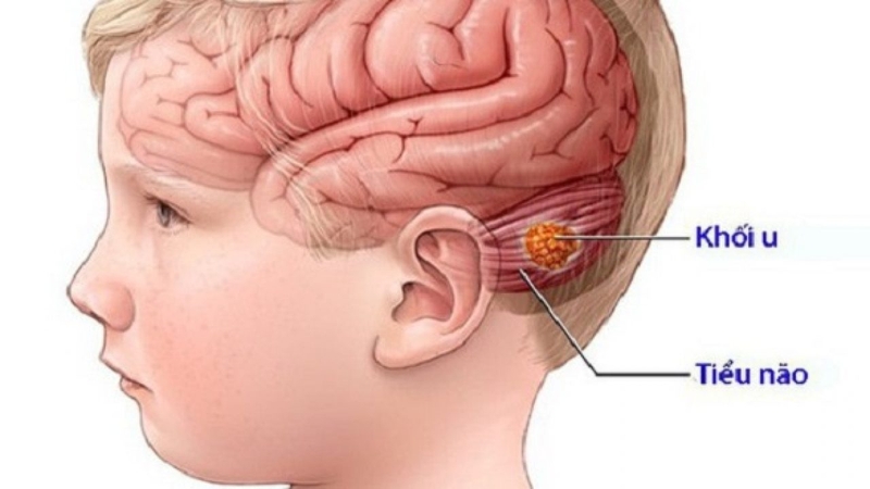 Các triệu chứng của hội chứng hố sau là gì?1