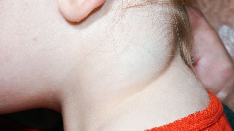 Hội chứng Hygroma kystique và những điều bạn cần biết 1