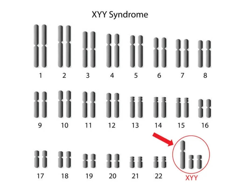 Hội chứng Jacobs: Nguyên nhân, triệu chứng và cách phòng ngừa
