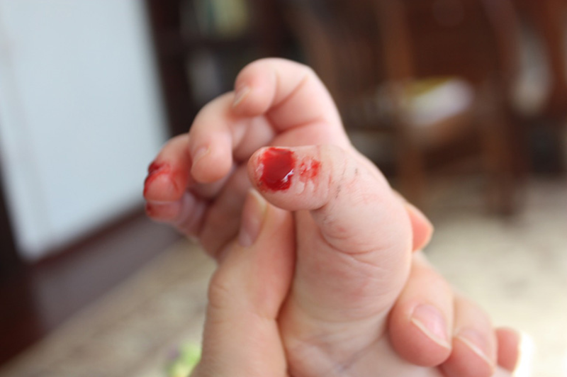 Hội Chứng Lesch-Nyhan – Căn bệnh “tự ăn thịt chính mình” đầy bí ẩn 3