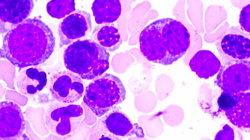 Hội chứng loạn sản tủy xương: Nguyên nhân gây bệnh và phương pháp điều trị 1