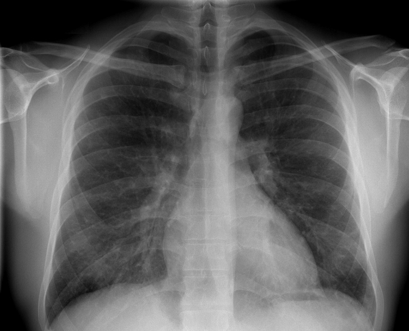 Hội chứng Loeffler: Triệu chứng, cách chẩn đoán và điều trị bệnh 3