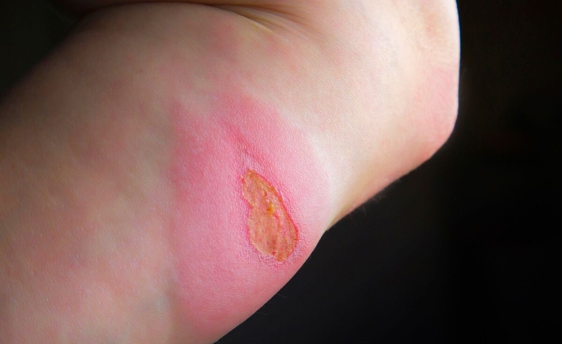 Hội chứng Lyell: Nguyên nhân, triệu chứng, cách chẩn đoán và các phương pháp điều trị