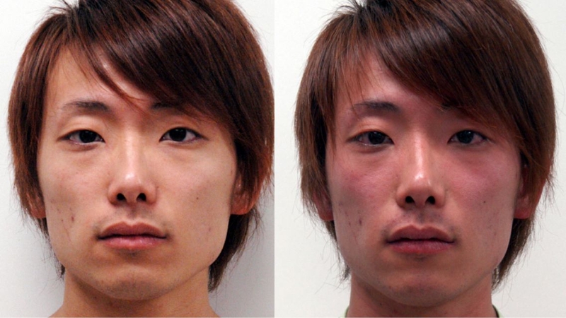 Da mặt đỏ bừng ngay sau vài ngụm rượu - dấu hiệu hội chứng đỏ mặt châu Á