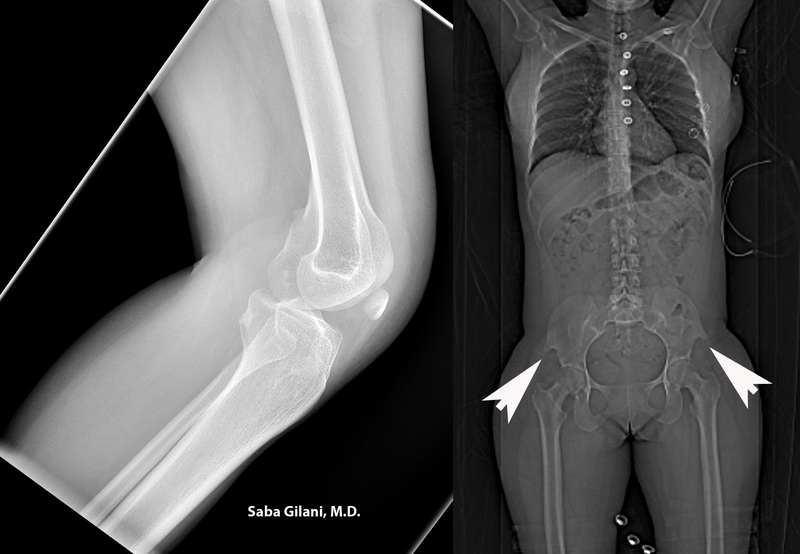 Hội chứng móng và xương bánh chè: Nguyên nhân, triệu chứng, chẩn đoán và điều trị 3