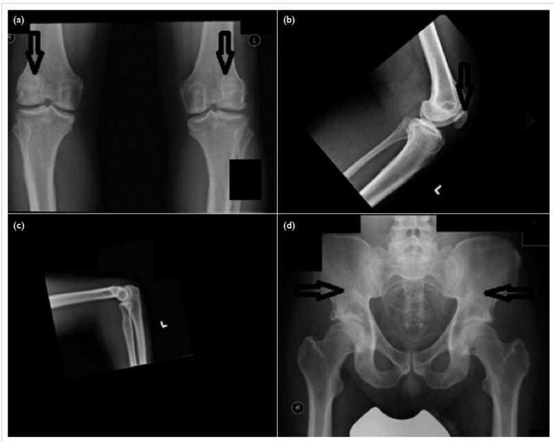 Hội chứng móng và xương bánh chè: Nguyên nhân, triệu chứng, chẩn đoán và điều trị 4