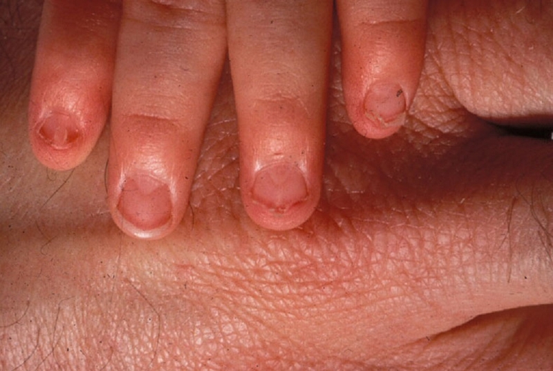 Hội chứng móng - xương bánh chè là thế nào? Các dấu hiệu nhận biết bệnh 2