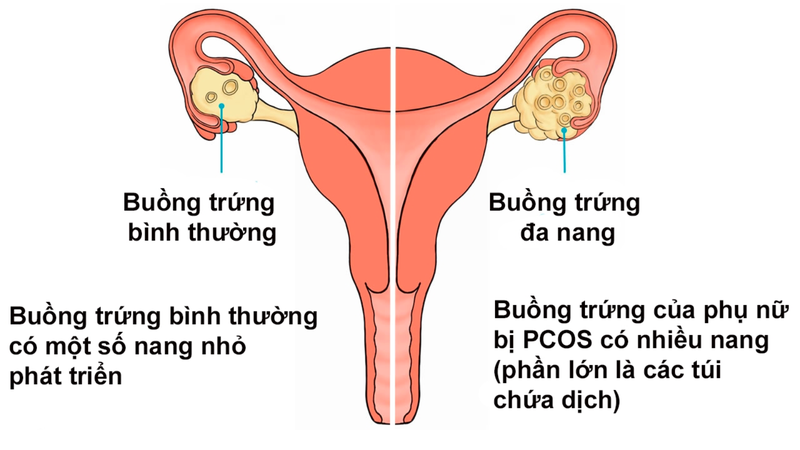 Hội chứng nam hoá là gì? Nguyên nhân, triệu chứng và cách điều trị 5