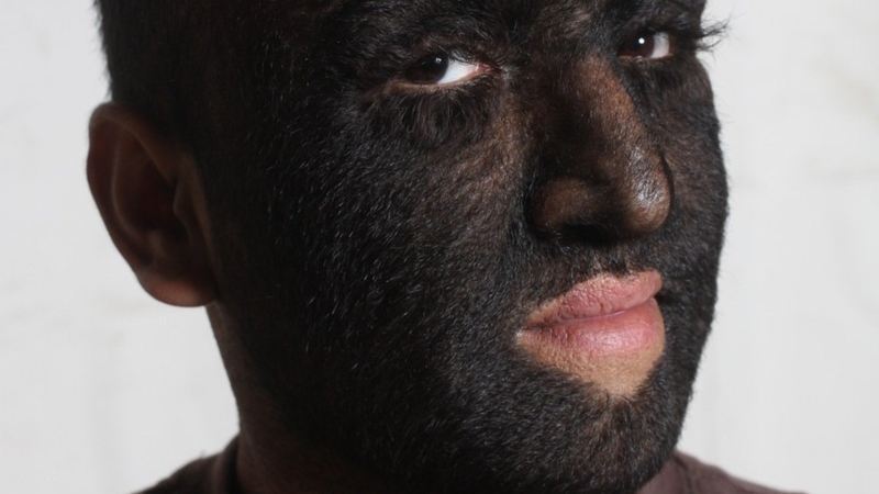 Hội chứng người sói và những điều cần biết 1.jpeg