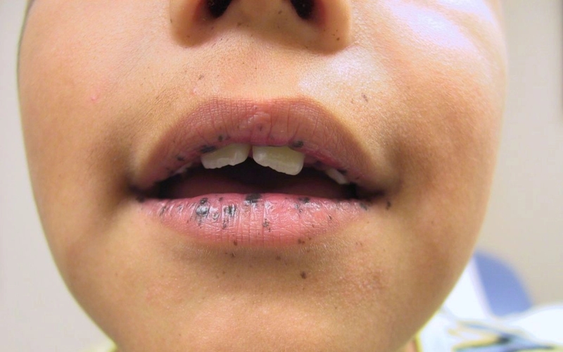 Hội chứng Peutz-Jeghers là gì? Liệu có hội chứng Peutz-Jeghers có phải dấu hiệu cho các bệnh ung thư hay không? 1