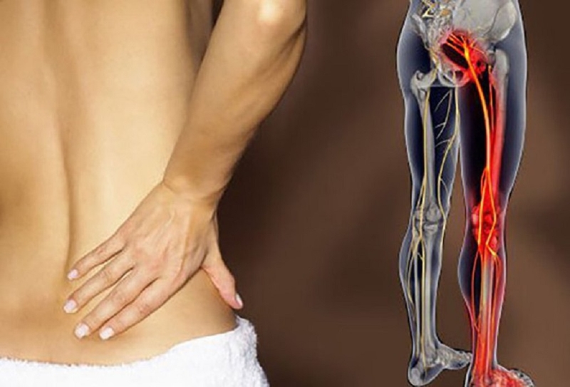 Hội chứng Piriformis: Nguyên nhân, dấu hiệu nhận biết và cách điều trị 2