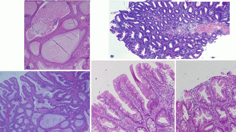 Tìm hiểu về hội chứng polyp hỗn hợp di truyền 1