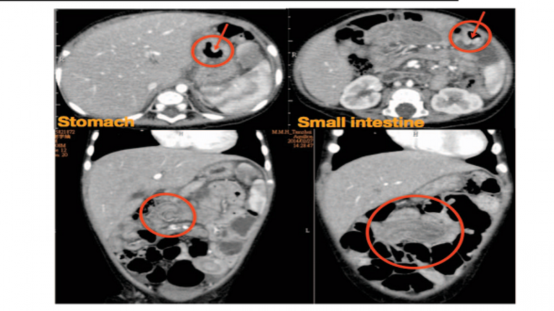 Những thông tin về hội chứng Polyp Juvenile1
