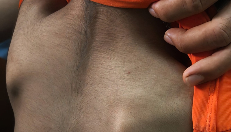 Hội chứng rậm lông và những điều cần biết