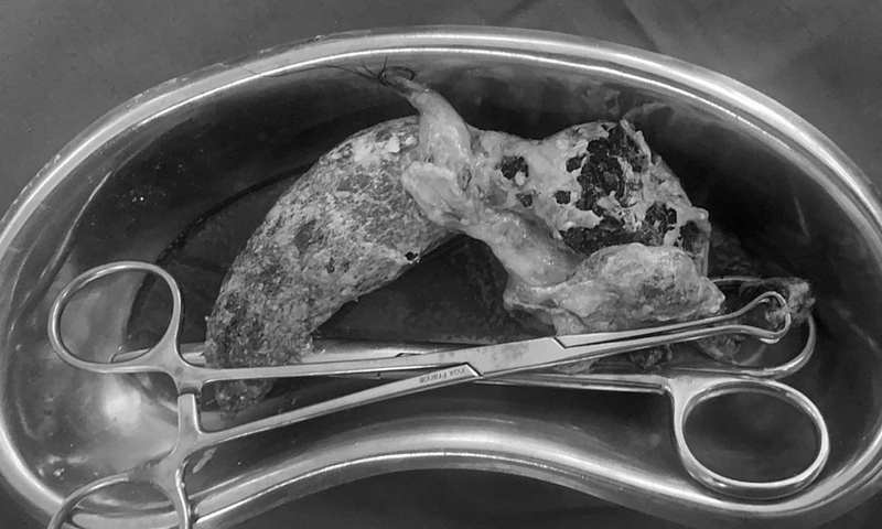 Hội chứng Rapunzel là gì? Nguyên nhân, dấu hiệu và hướng điều trị tốt nhất 3