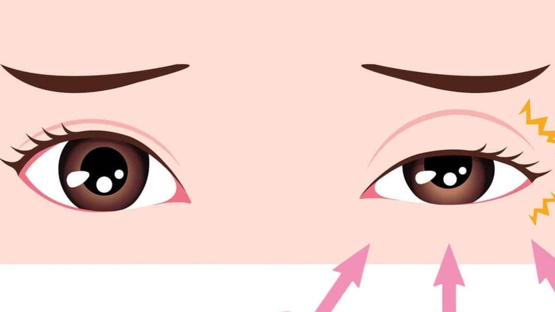 Hội chứng rung giật cơ lành tính và những điều cần biết 1.jpeg