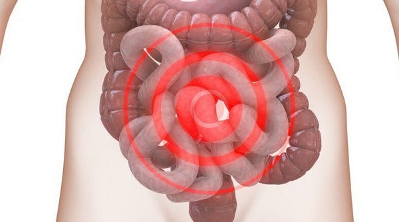 Hội chứng ruột kích thích có nguy hiểm không? Cách điều trị hội chứng ruột kích thích.