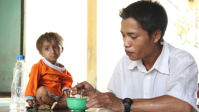 Hội chứng seckel (người tí hon) là gì? Nguyên nhân và triệu chứng của bệnh 1