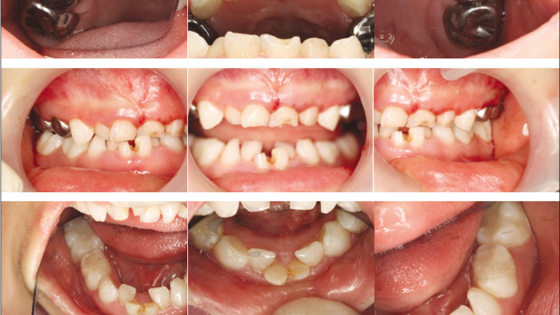 Hội chứng Silver - Russell là gì? Nguyên nhân, triệu chứng và cách điều trị 4