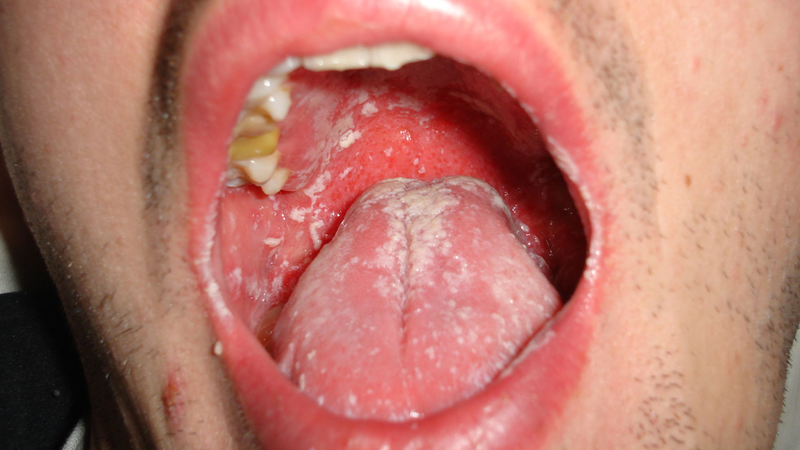 Hội chứng suy giảm miễn dịch: Triệu chứng, điều trị và phòng ngừa 3