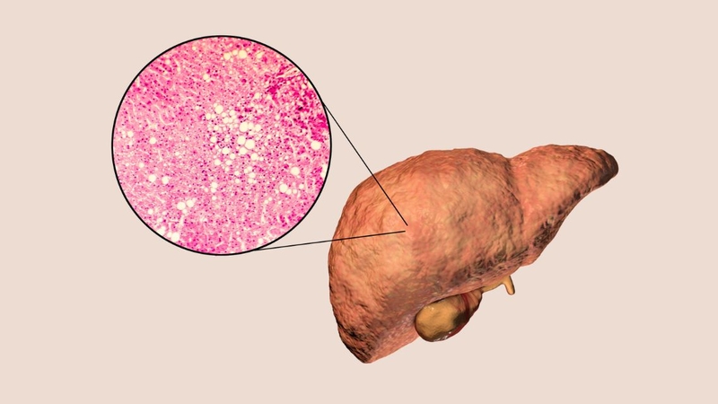 Giải mã hội chứng suy tế bào gan: Từ nguyên nhân đến cách phòng ngừa 1