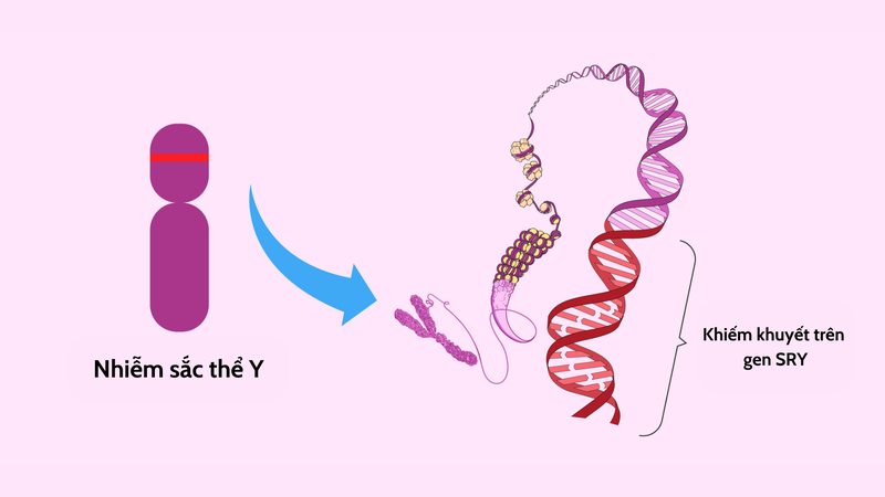 Hội chứng Swyer: Nguyên nhân, triệu chứng, chẩn đoán và điều trị 4