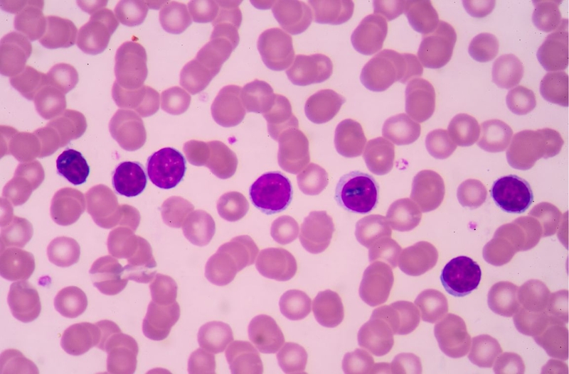 Tìm hiểu về hội chứng tăng sinh lympho bào liên kết X 1