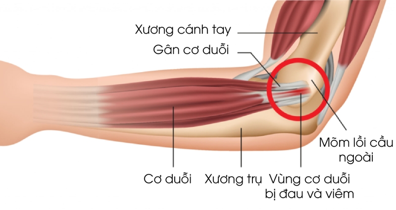Hội chứng Tennis Elbow là gì? Cách điều trị hiệu quả nhất 1