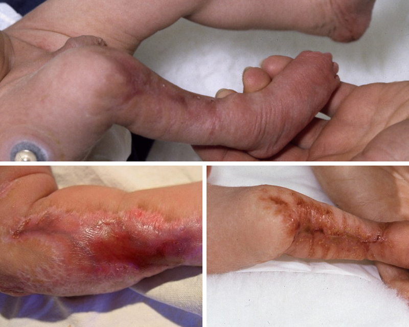 Hội chứng thủy đậu bẩm sinh ở trẻ sơ sinh và cách phòng ngừa 2