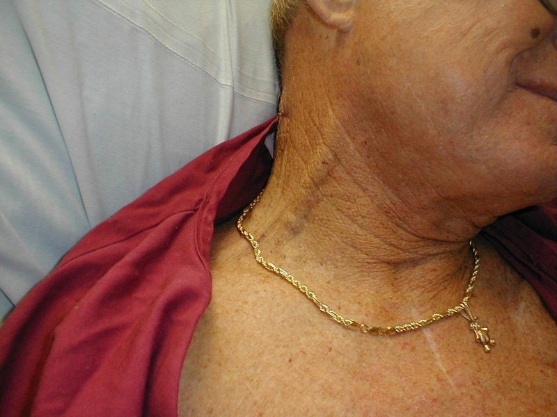 Hội chứng tĩnh mạch chủ trên: Nguyên nhân, triệu chứng, chẩn đoán và phương pháp điều trị 2