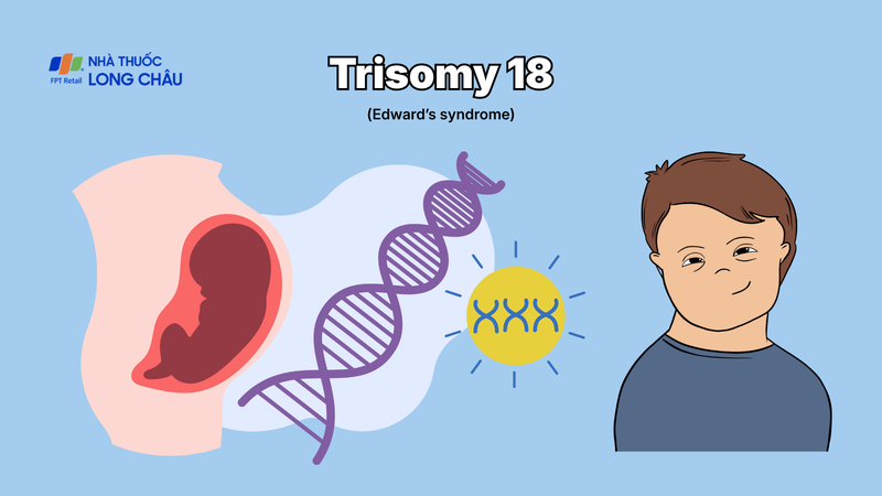 Trisomy 18 còn được biết đến với tên gọi là hội chứng Edwards