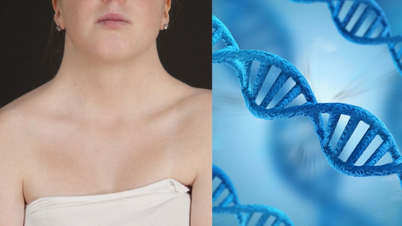 Hội chứng Turner có di truyền không là nỗi băn khoăn của nhiều độc giả