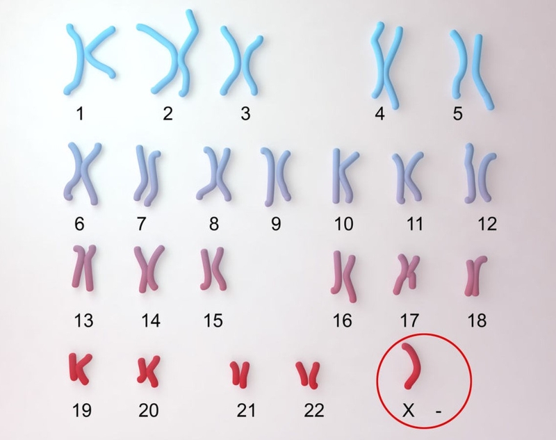 Hội chứng Turner: Nguyên nhân, biểu hiện, điều trị ra sao? 1